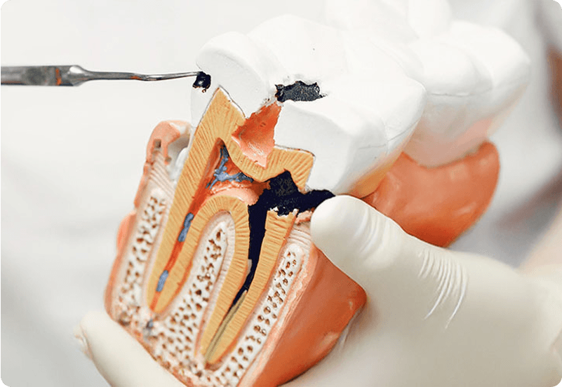 Spanish Dentist showcasing a cavity filling display