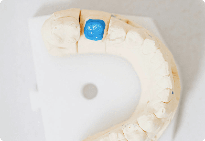 Dental Crowns in Spain hero image