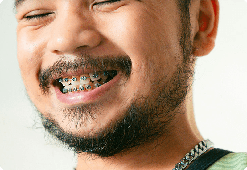 Teeth cleaning in Spain hero image